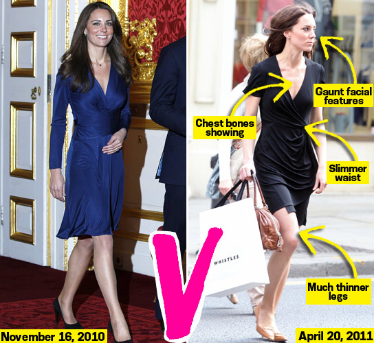 Bonnie Says: Poor Kate Middleton, You're Skin & Bones! You From An Eating Disorder Like Princess Diana? Hollywood Life