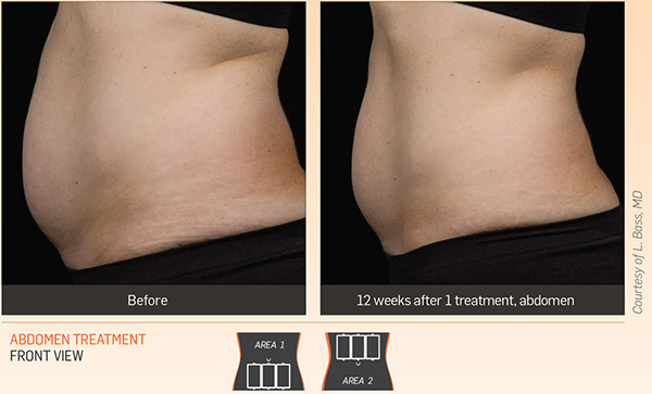 sculpsure-results-1