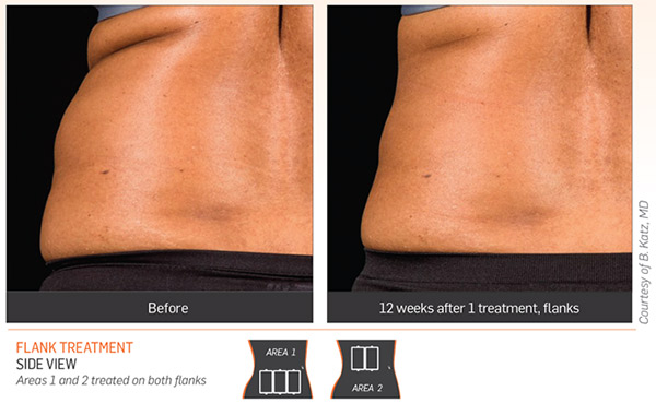 sculpsure-results-3