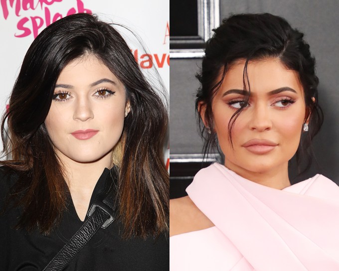 Stars Who Have Admitted To Getting Lip Injections: Their Before & After Pouts
