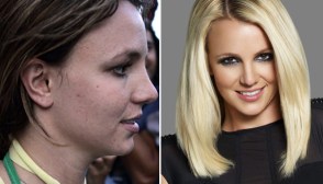 Britney Spears Acne
