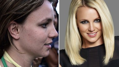 Britney Spears Acne