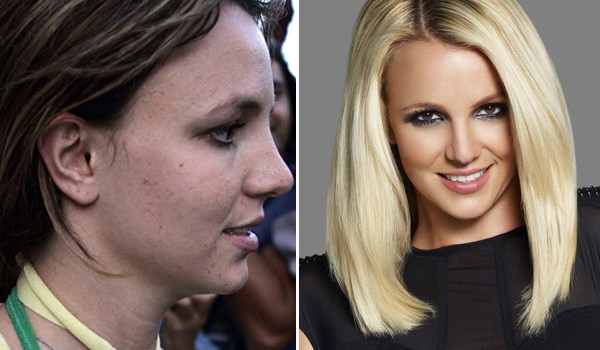 Britney Spears Acne