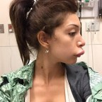 farrah-abraham-duck-lips-surgery-1
