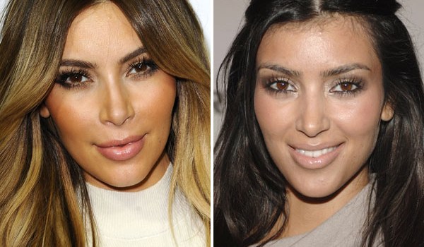 Kim Kardashian Botox