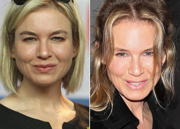 Renee Zellweger’s Face — She Got Plastic Surgery, Docs Say – Hollywood Life