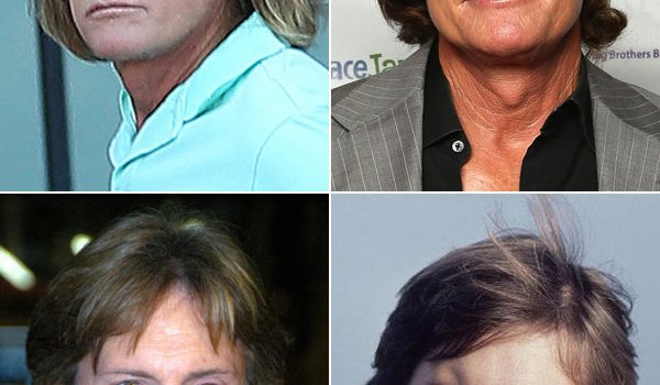 Bruce Jenner Plastic Surgery