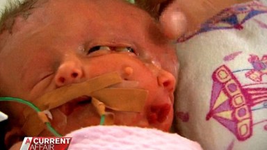 Australian Conjoined Twin Girls Die