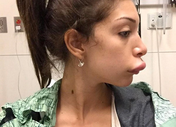 Farrah Abraham S Botched Surgery On Lips She ‘had A Massive Attack Hollywood Life