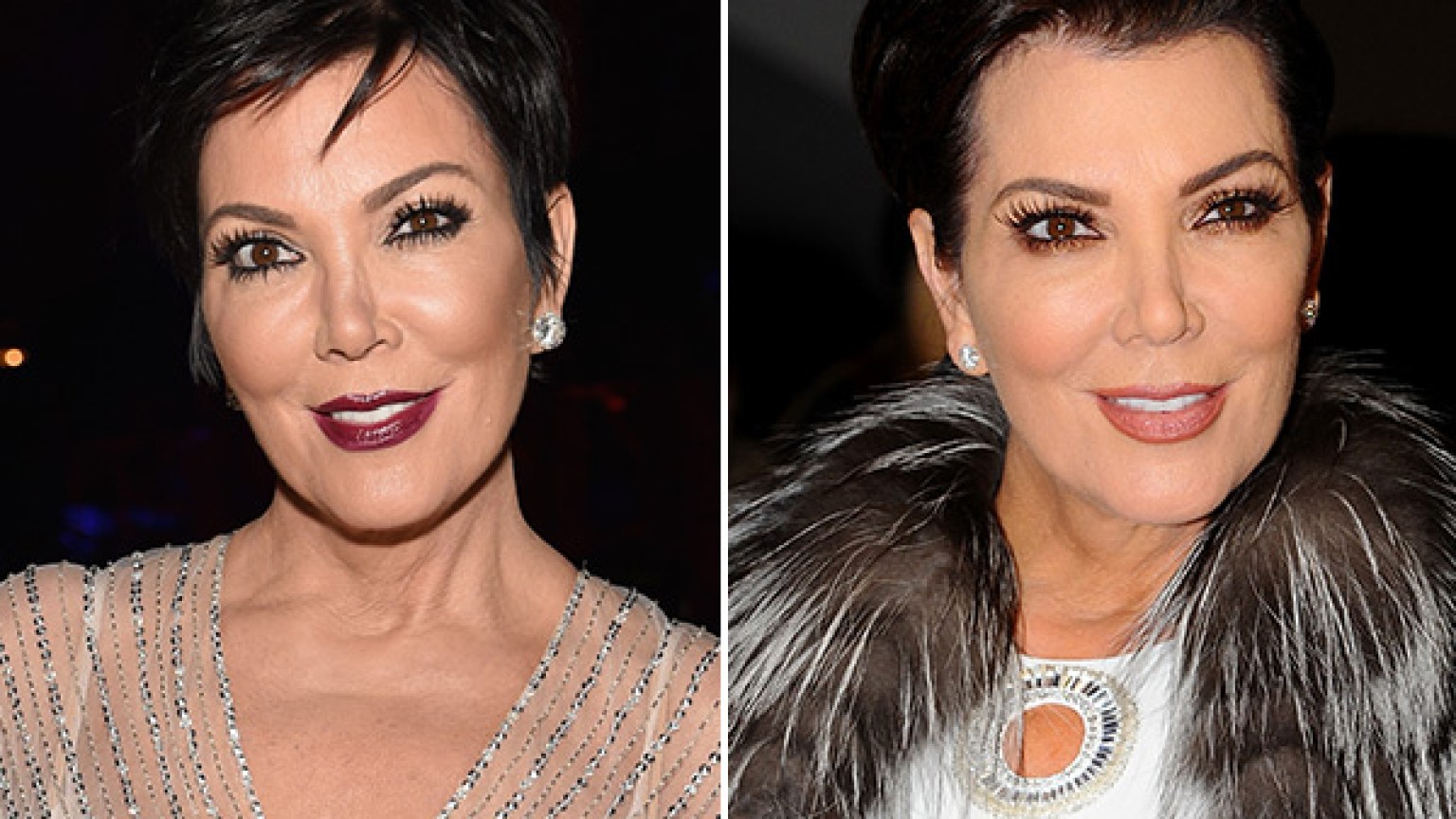 Kris Jenner Plastic Surgery 2025 News 