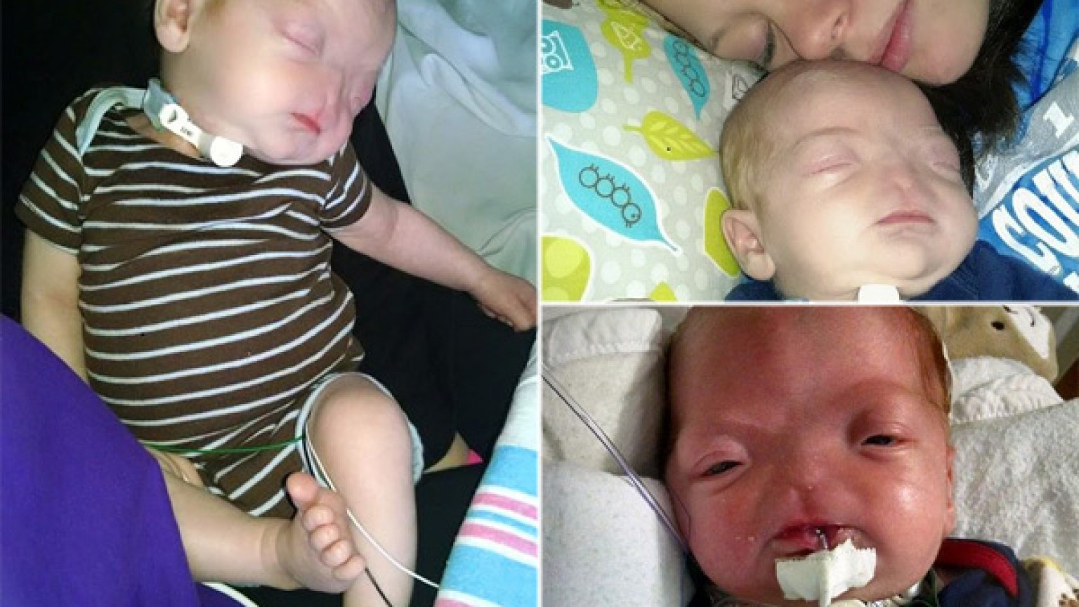 PIC Baby Born Without Nose: Eli Thompson Suffers From Rare