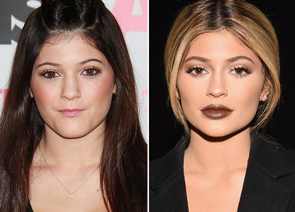 Kylie Jenner’s Lip Fillers — Log-Lasting Filler Approved: Juvederm ...