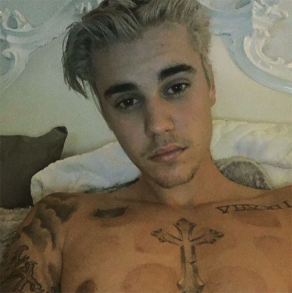 Justin Bieber’s Cupping Marks — Why Did He Need Treatment On His Back ...