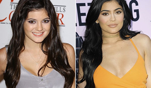 Celebrities Before After Plastic Surgery Photos