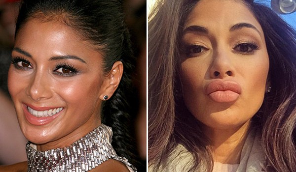 Nicole Scherzinger Lip Injections