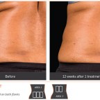 sculpsure-results-3