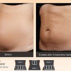 sculpsure-results-4