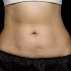 sculpsure-results-6