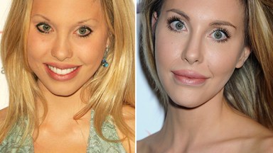 Chloe Lattanzi Plastic Surgery