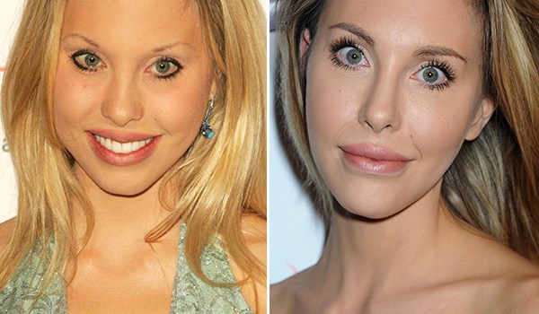 Chloe Lattanzi Plastic Surgery