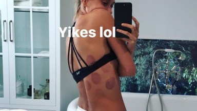 Hailey Baldwin Cupping