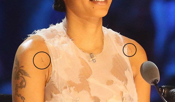 Mel B Bruises