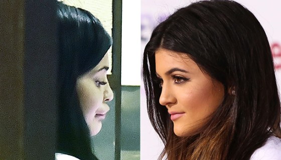 Kylie Jenner's lips before & after baby