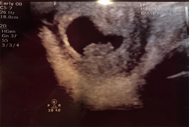 xxxtentacion baby ultrasound