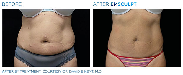 How To Drop Ab Fat & Flab Without Dieting: I Tried Emsculpt