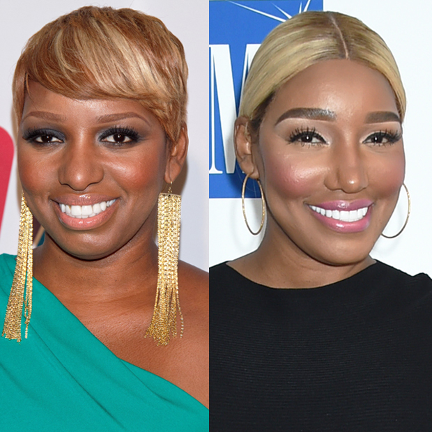 NeNe Leakes before & after plastic surgery.