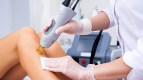 hair removal laser