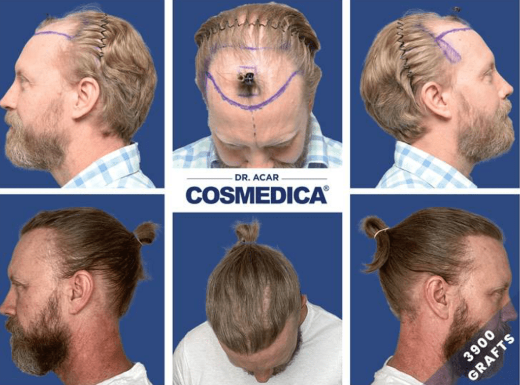  hair transplant before and after at Cosmedica Clinic.