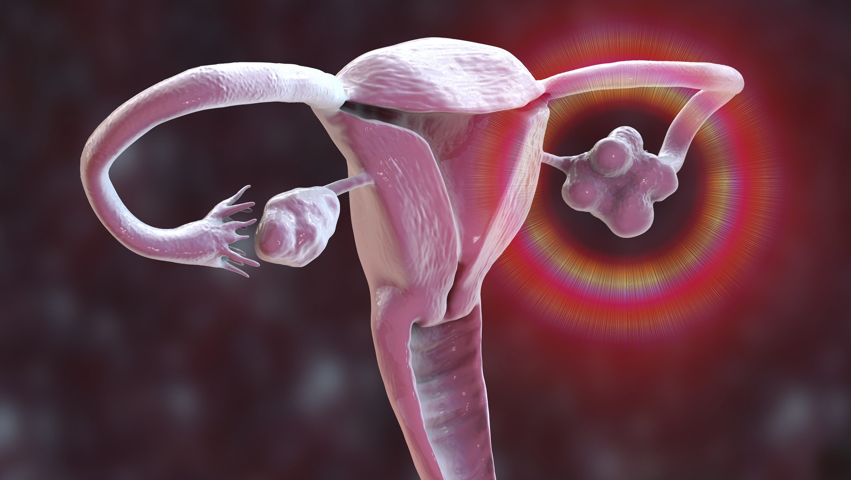 What Is Polycystic Ovary Syndrome? New name, PMOS Explained