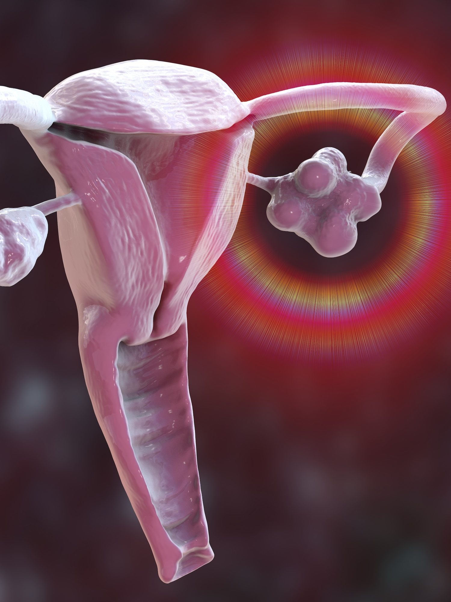What Is Polycystic Ovary Syndrome? New name, PMOS Explained